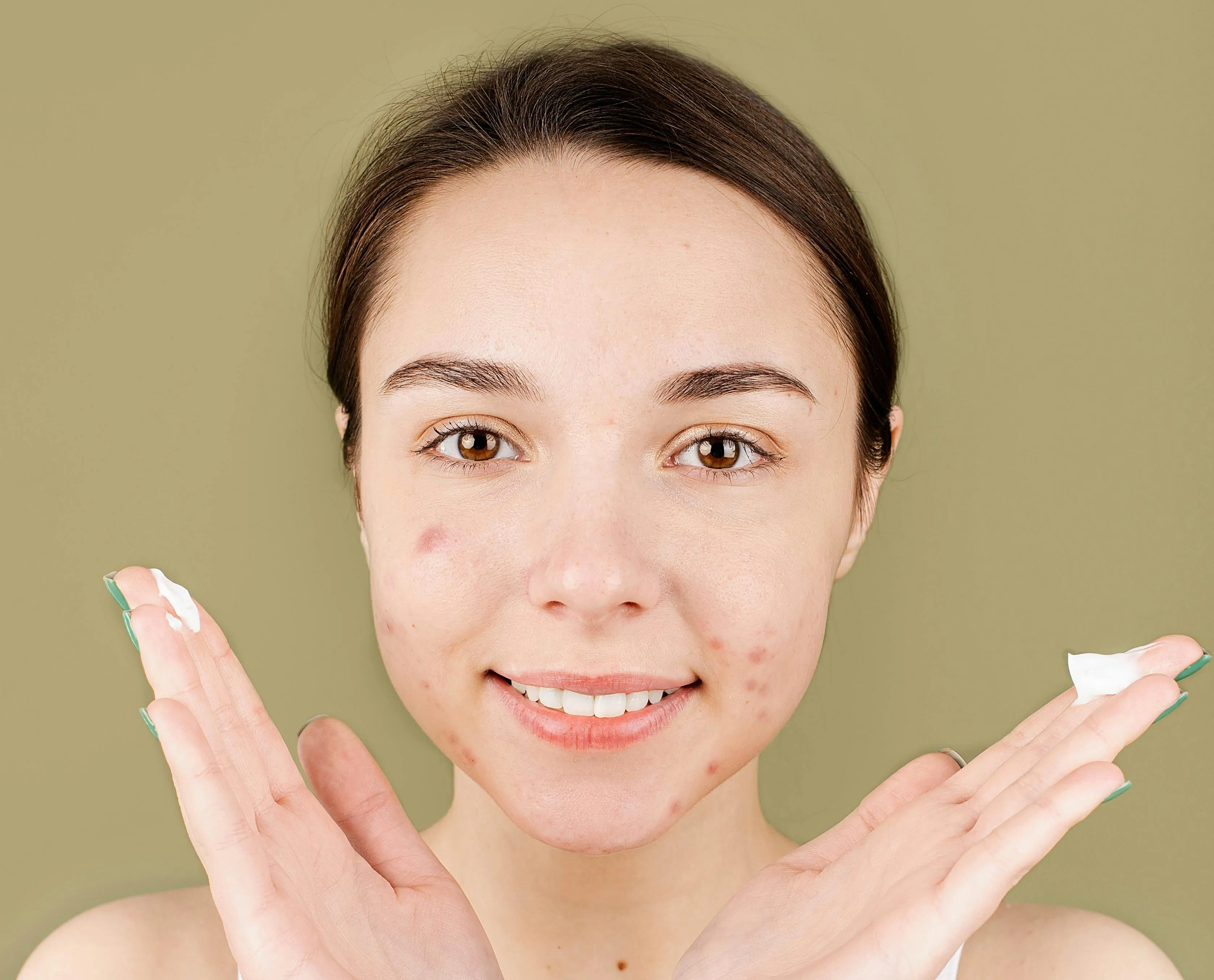 Woman with calmer adult-acne skin after starting a treatment plan