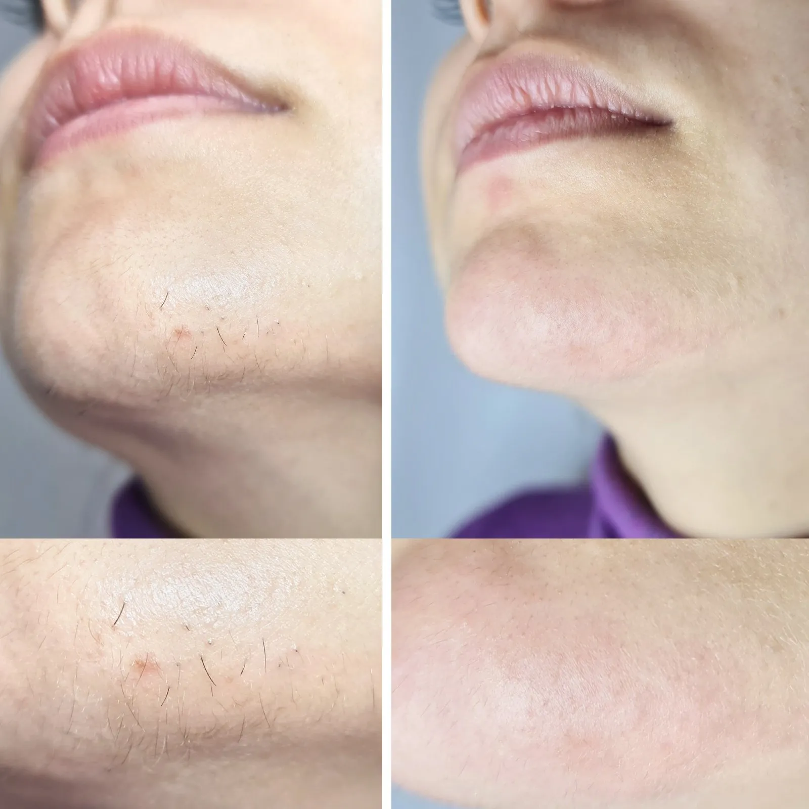 Confident woman after starting a facial hair treatment plan